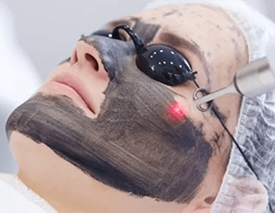 CARBON FACIAL