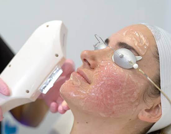 LASER PHOTOFACIAL